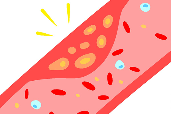 動脈硬化の説明