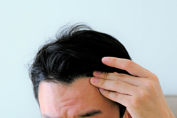 AGAの症状と原因